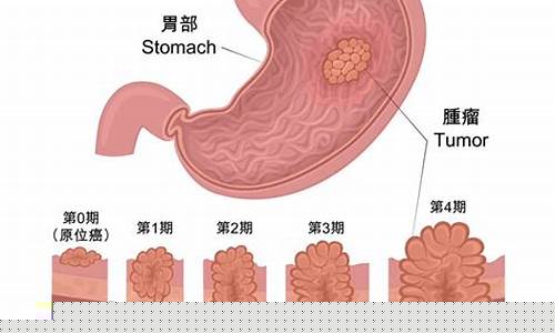 电子烟胃癌(电子烟癌症)